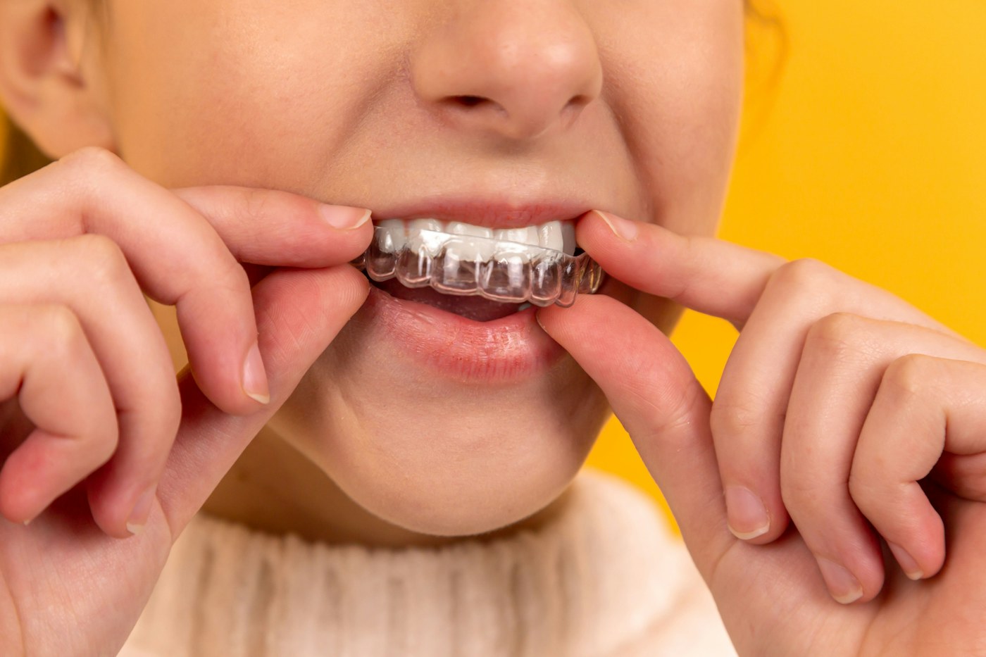 Professional Whitening